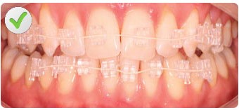 quick straight teeth clear fixed braces