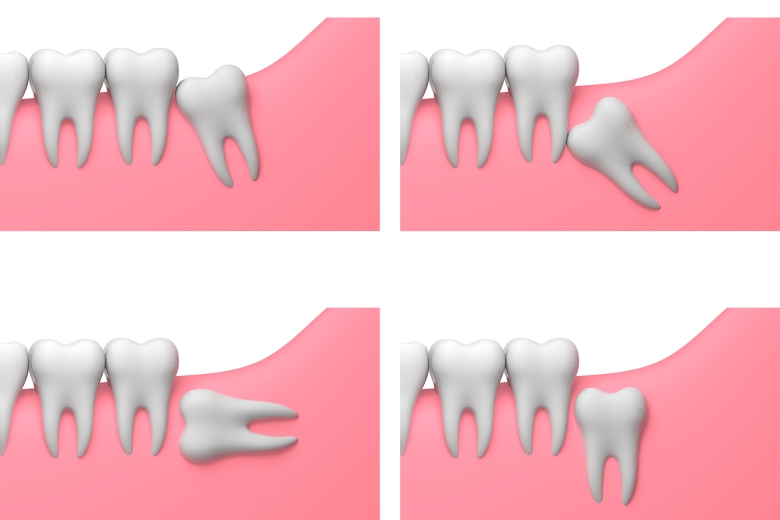 four types of wisdom teeth impactions