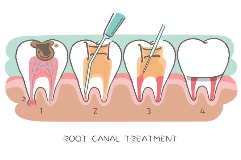 root canal treatment 4 steps diagram
